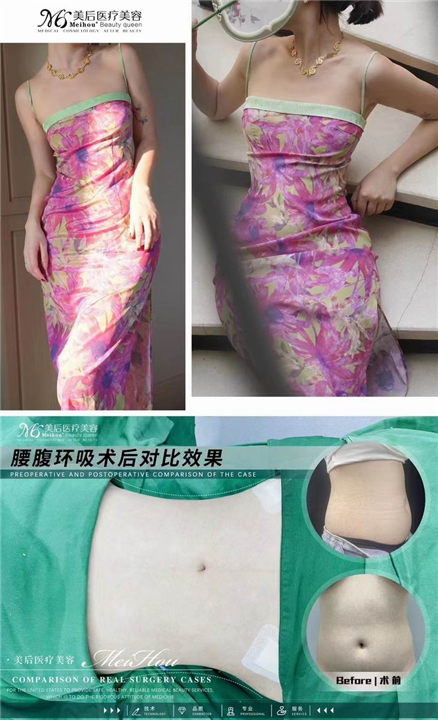 抽脂术后常见的并发症及处理措施，值得收藏！