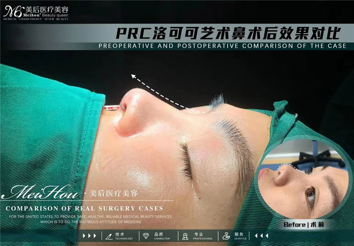 关于隆鼻你关心的什么问题