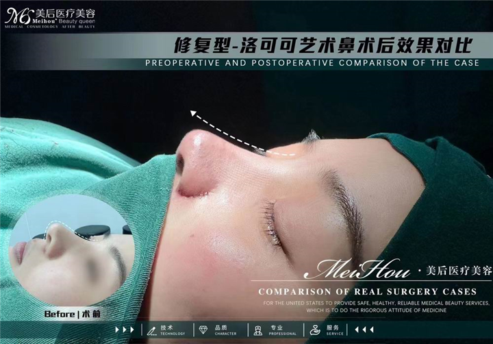 全肋隆鼻和半肋隆鼻的区别是什么？