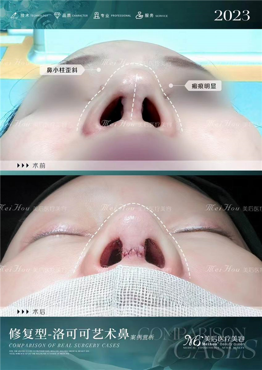 隆鼻，适合自己的才是**的！