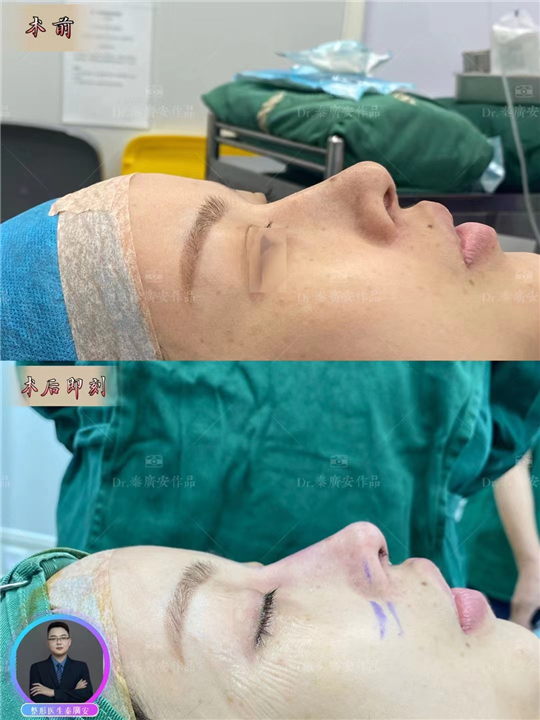 秦广安医生鼻修复整形案例
