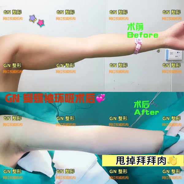 上海GN整形|GN网红整形医院