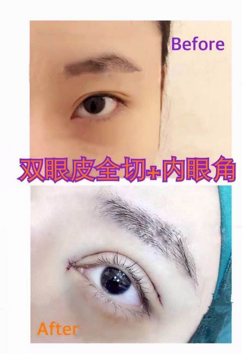 上海埋线双眼皮价格是多少