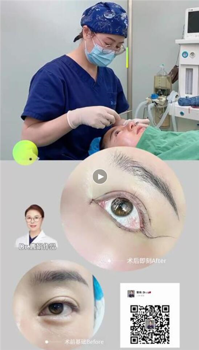 曹娟医生眼部案例