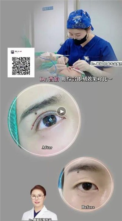 曹娟医生眼部案例