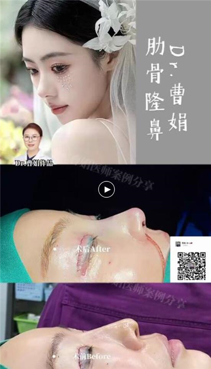 上海曹娟整形医生鼻部案例