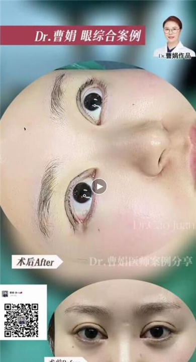 曹娟医生眼部案例