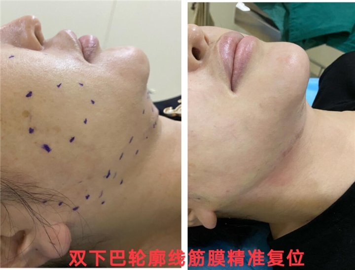 剥离微整下颚线
