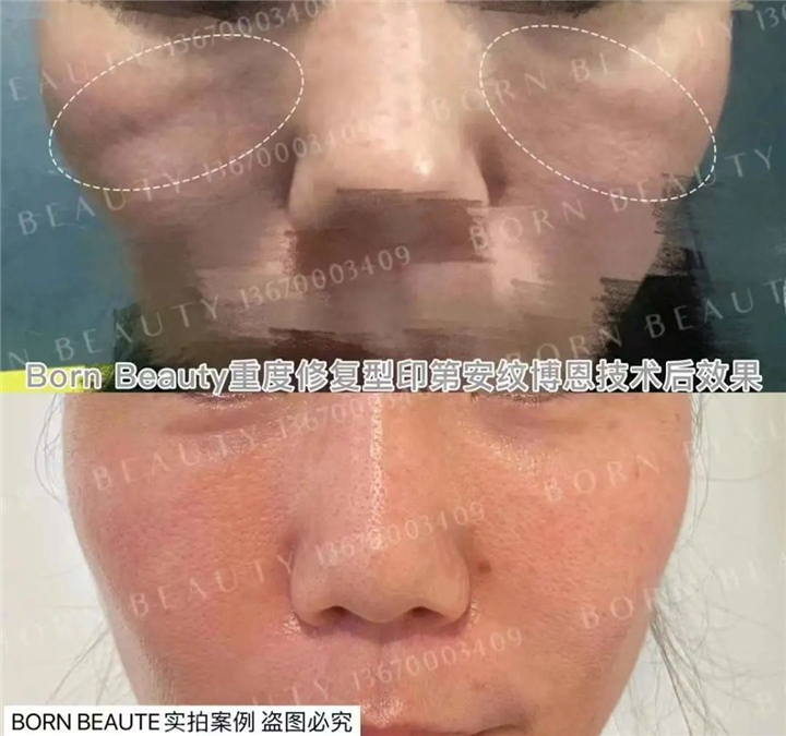 印第安纹祛除效果对比，剥离和填充哪个好？