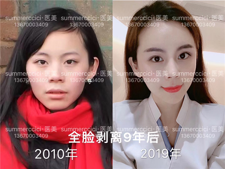 全脸剥离9年多 