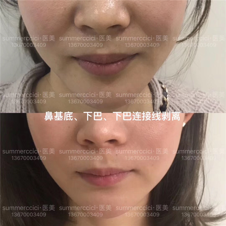 鼻基底剥离5个月 