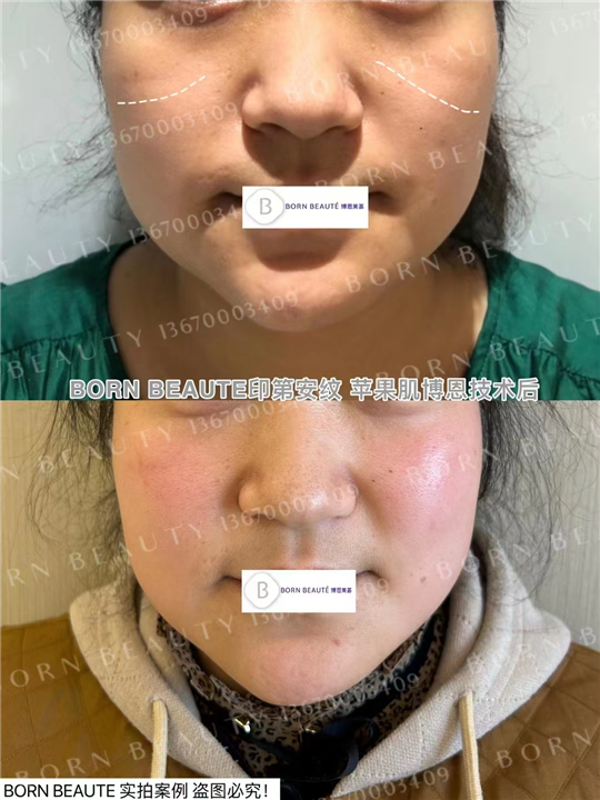 印第安纹会自己消退吗？医美手段效果怎么样？