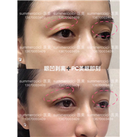 pc美眼和剥离眼凹 
