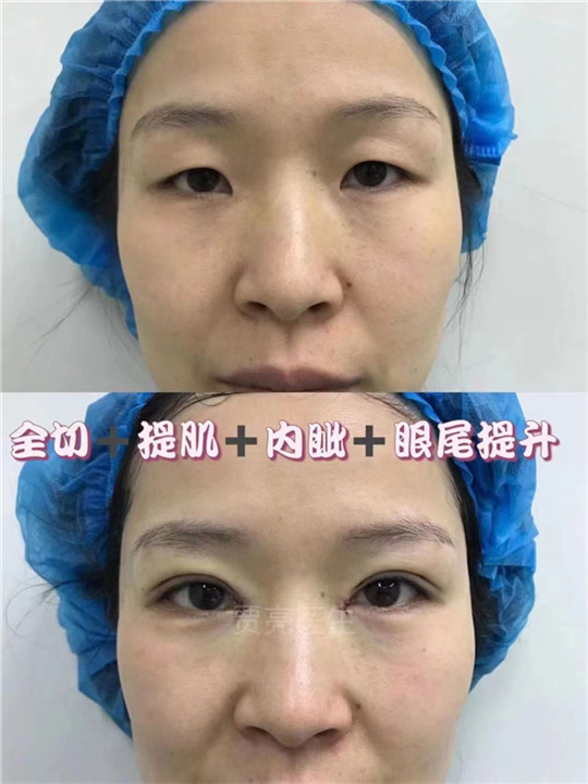 郑州眼部整形专家贾亮