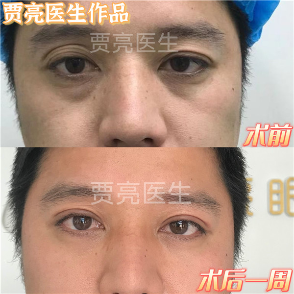 贾亮双眼皮案例宽