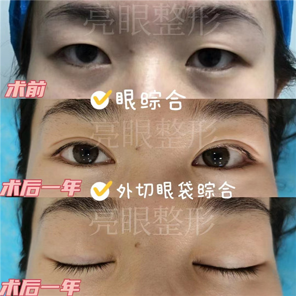 反复贴双眼皮贴，会造成眼部皮肤松弛吗？