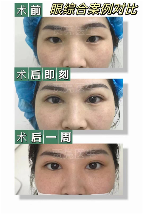 做眼部手术，出现疤痕增生，是哪些原因造成的？