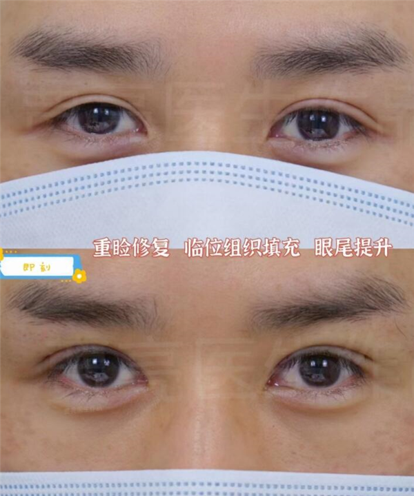 术后快速恢复的小方法