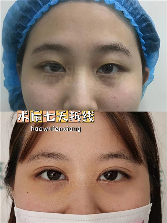 割完双眼皮留下疤痕就是疤痕体质了吗