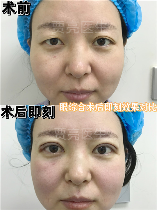 哪些人适合开眼角？