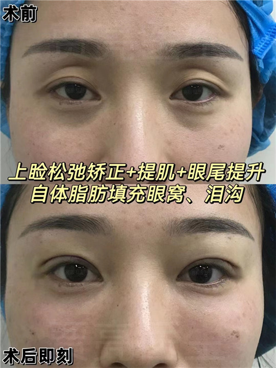 眼袋的出现是眼部衰老的表现之一