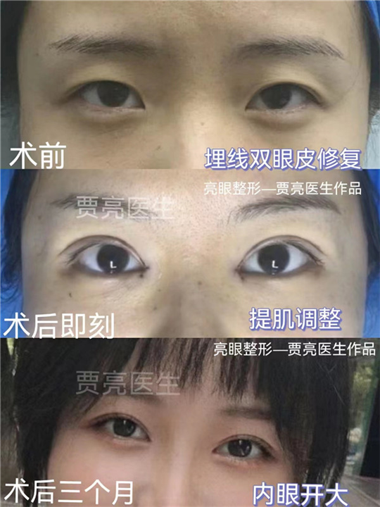 眼皮下垂，双眼皮变成三眼皮还能恢复吗？