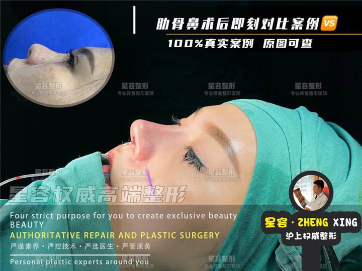 肋骨鼻综合肋骨疼几天？