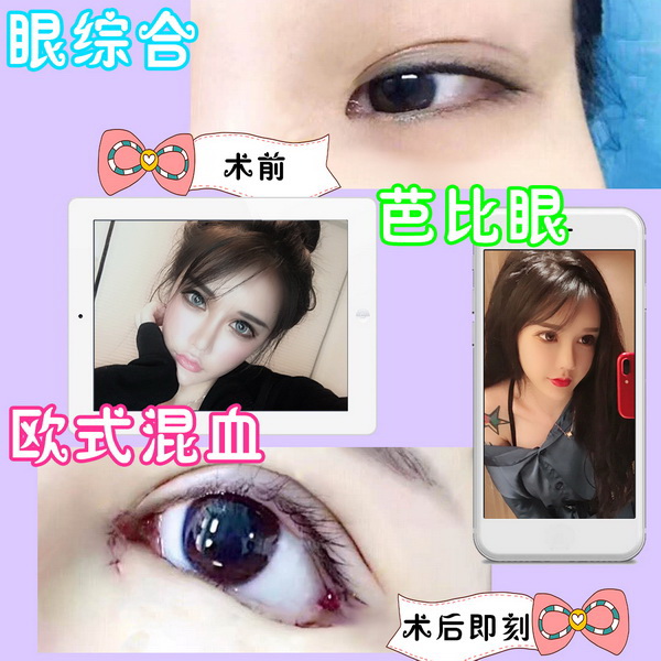 西安眼综合整形 