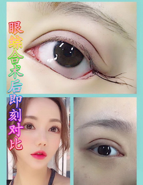 西安眼综合整形 
