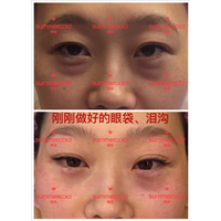 刚刚做好的眼袋泪沟