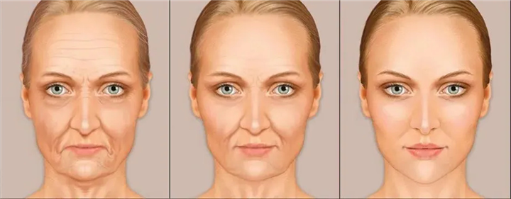 印第安纹会自己消退吗？哪些方法能消退印第安纹？