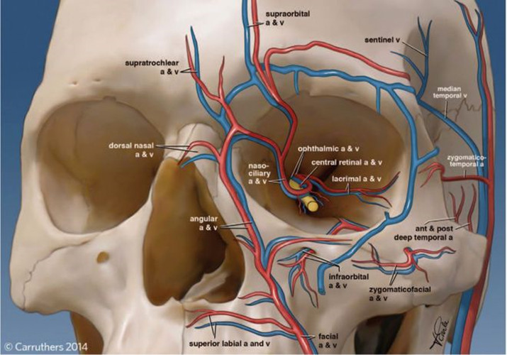 做印第安纹剥离，后期使用射频类仪器会加深印第安纹吗？