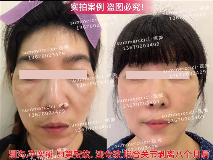 印第安纹剥离一次有用吗？到底要剥离多少次呢？