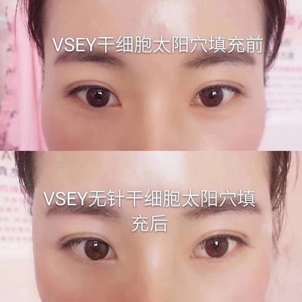 无针医美|无针医美是什么