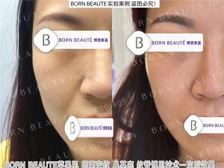 想要修复印第安纹，哪种修复方式性价比更高呢？