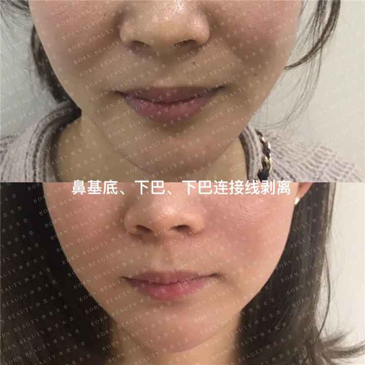 鼻基底下巴下巴连接线剥离