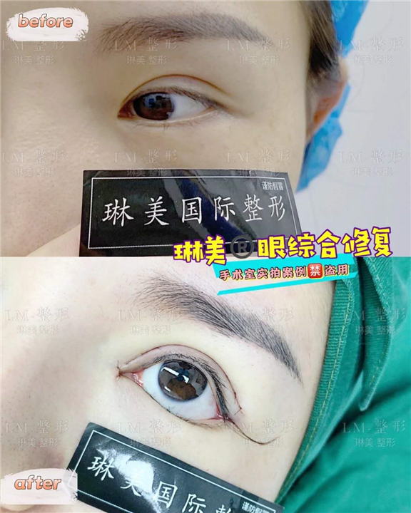 上海眼部整形修复