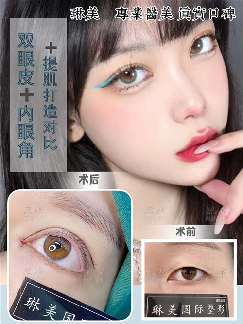 上海琳美眼综合整形