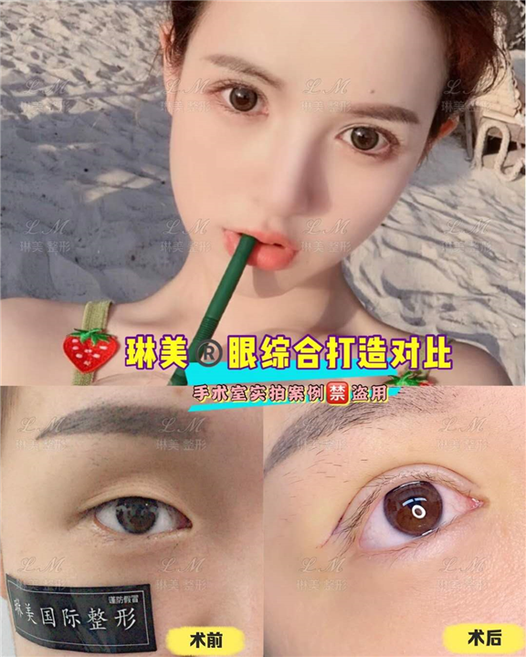 上海琳美眼综合整形