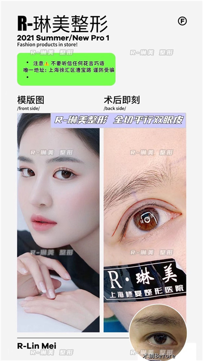 琳美眼部整形