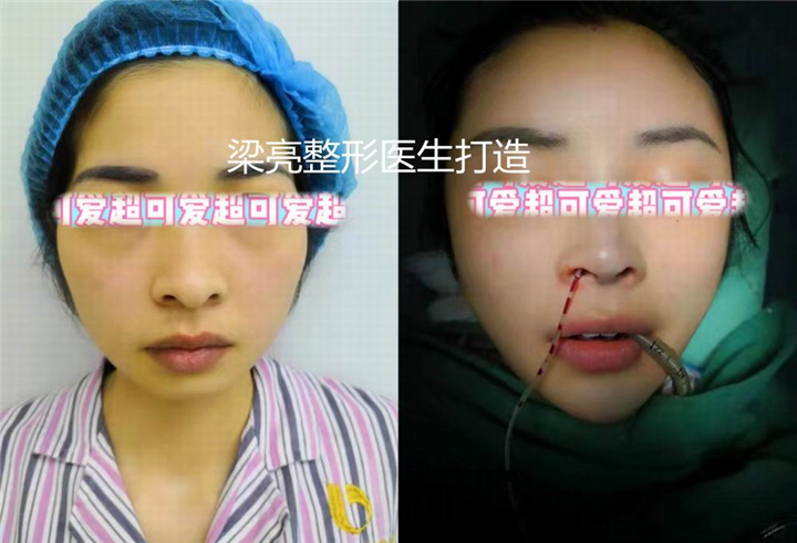 梁亮鼻整形
