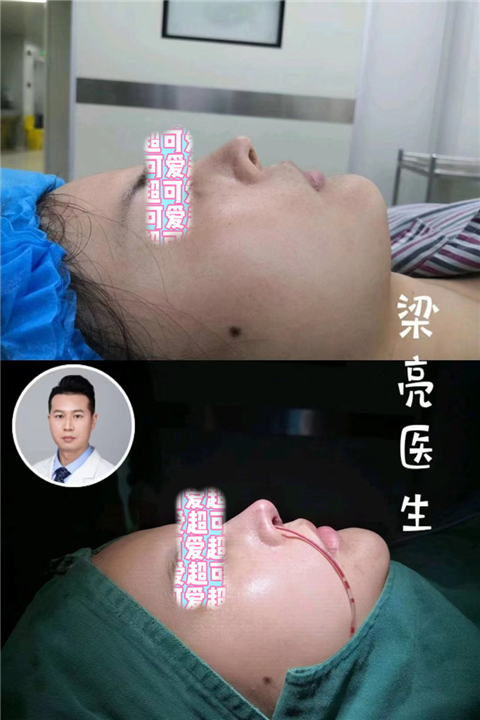 梁亮鼻综合案例