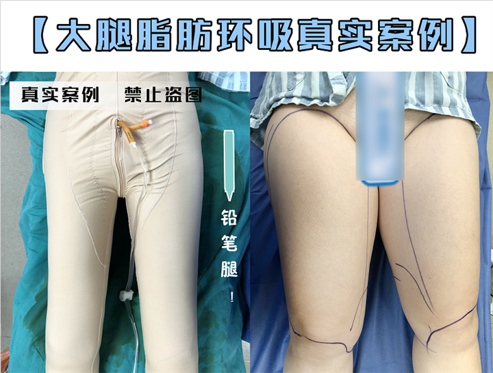 上海吸脂整形医院_上海抽脂整形哪家好 