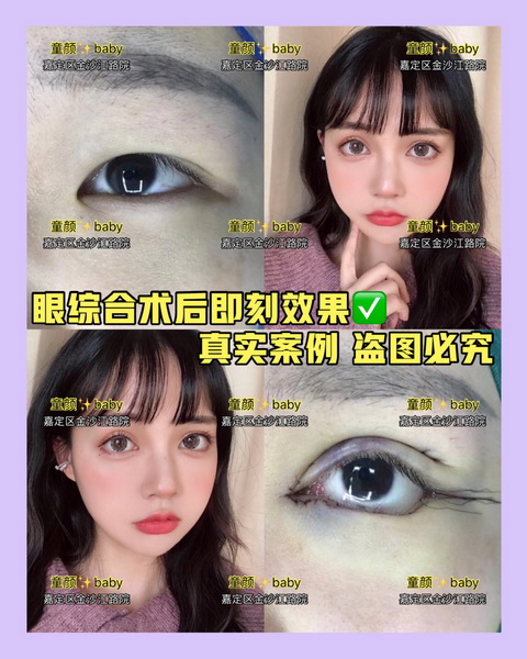 上海芭比眼整形|上海网红全脸打造