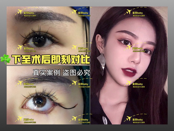 上海专业整形修复|上海芭比眼整形