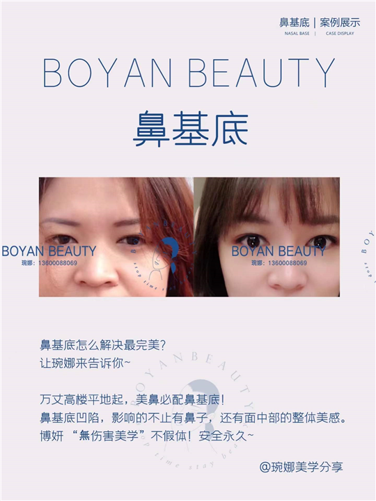 鼻基底剥离