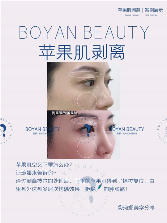苹果肌剥离
