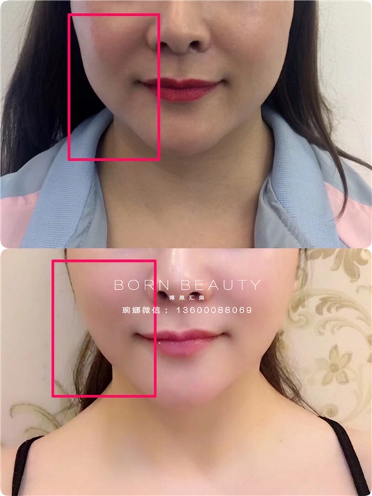 组织复位全脸提升 