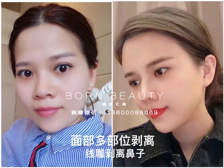 剥离微整能维持几年