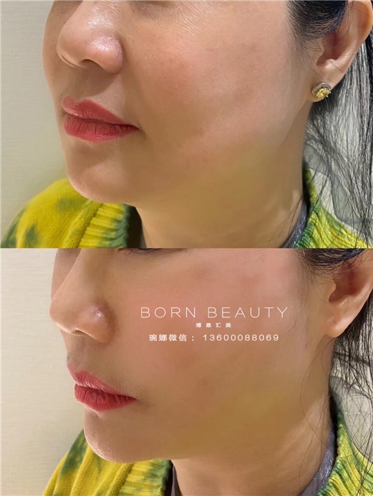 组织复位全脸提升